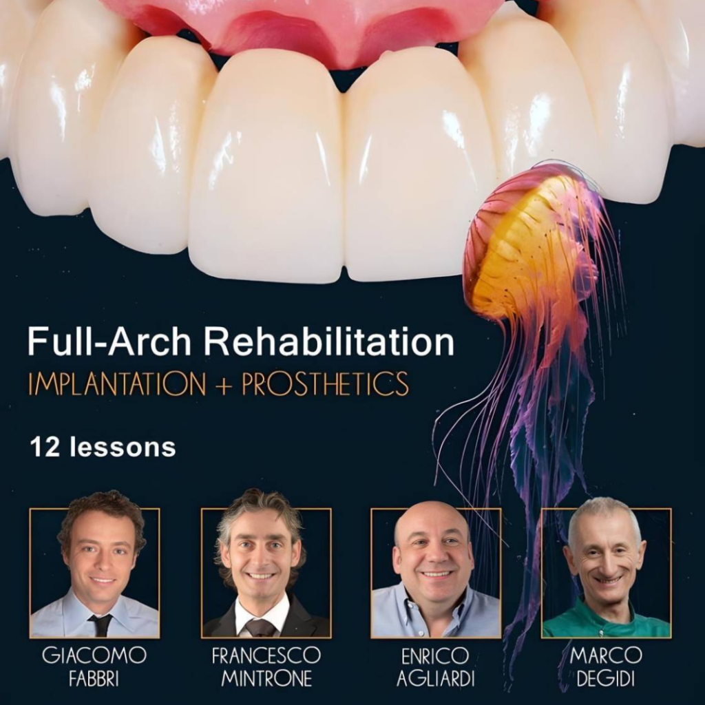 Full arch rehabilitation